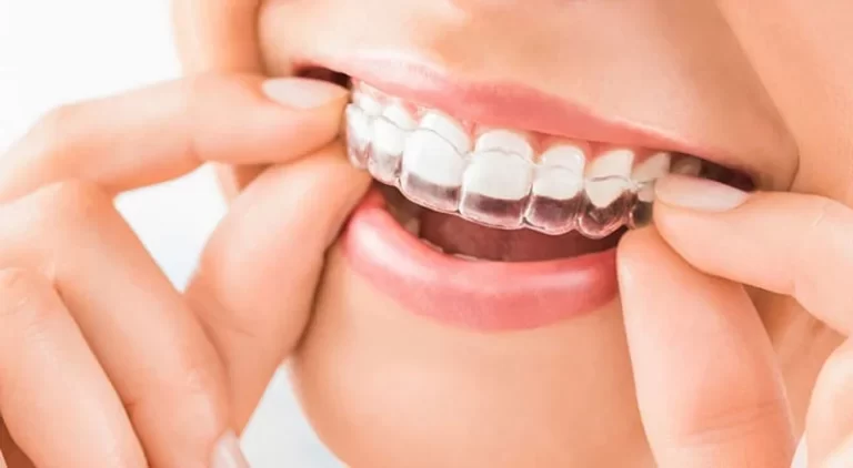 Invisalign Revolution: Revolutionizing Orthodontic Treatment